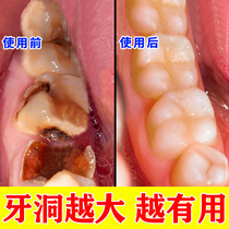 (Dental Identical) Farewell Tooth Decay Wormhole Tooth Black Caveat Tooth Decay Tooth Repair Tooth Cave Yourself BAD TOOTH