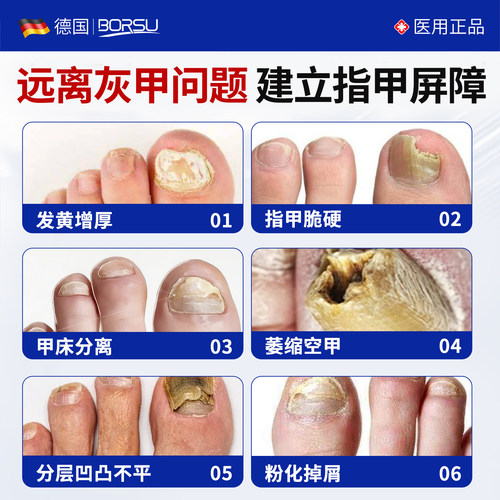 德国BORSU灰指甲专用甲沟正品旗舰店趾指甲膏冰醋酸涂剂剪指刀炎 - 图2