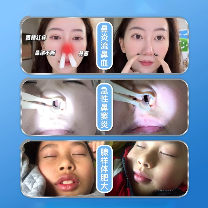 史医生穴位敷贴鼻炎贴急慢性鼻炎过敏性鼻炎鼻窦炎鼻塞通鼻膏贴