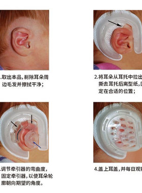 【院线同款】耳朵矫正器