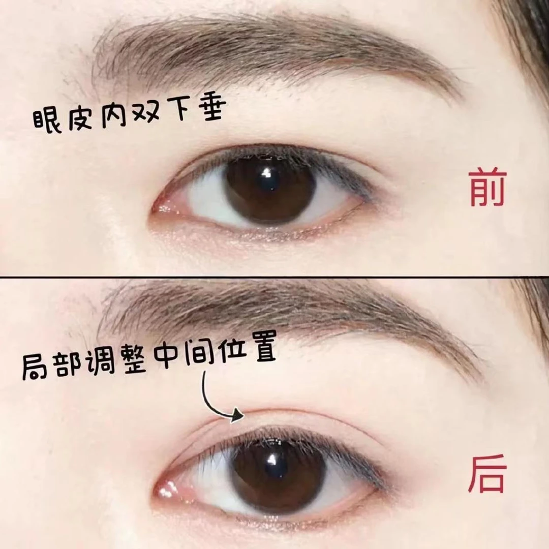 【下单立减50】蕾丝款双眼皮贴迷你局部调整喷水式美目贴隐形JW2 - 图3