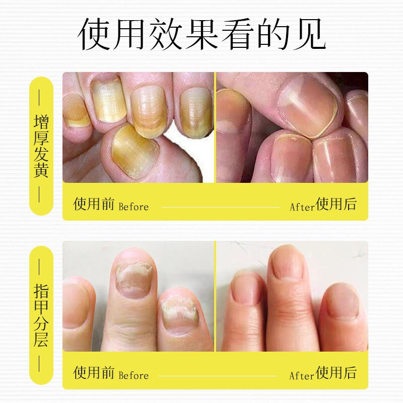 仁和灰指甲专用冰醋酸30涂剂 tm软膏 淮南药之都大药房保健理疗