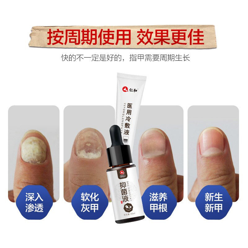 仁和灰指甲抑菌液冰醋酸正品专用液 淮南药之都大药房保健理疗