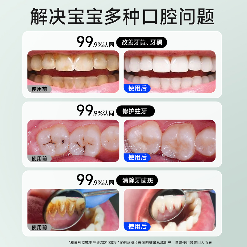 儿童牙膏含氟防蛀牙3-6-12岁牙科修复龋齿抗敏换牙期去牙黑非吞咽
