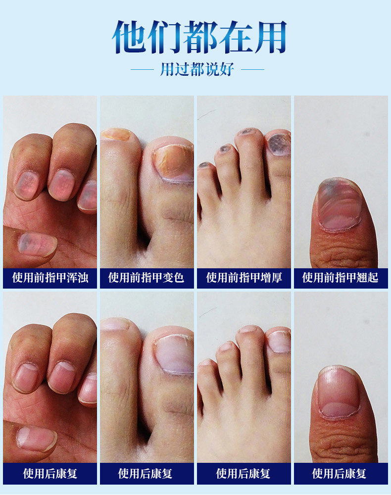 北京同仁堂灰指甲甲沟炎修脚剪刀 小禾诗蔓医疗器械保健理疗