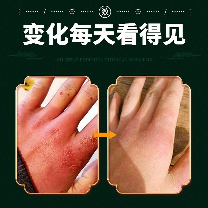 王泰林 冻疮膏 30g 天猫优惠券折后￥9.9包邮（￥19.9-10）