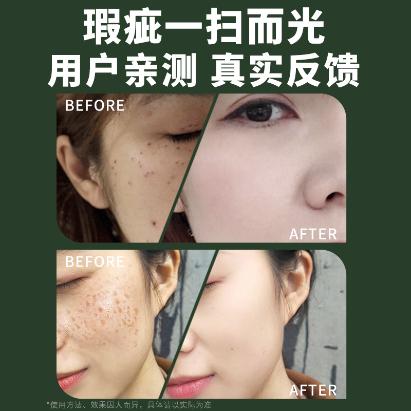 法国vlvee小白点痣笔美容院专用 vlvee电子美容仪