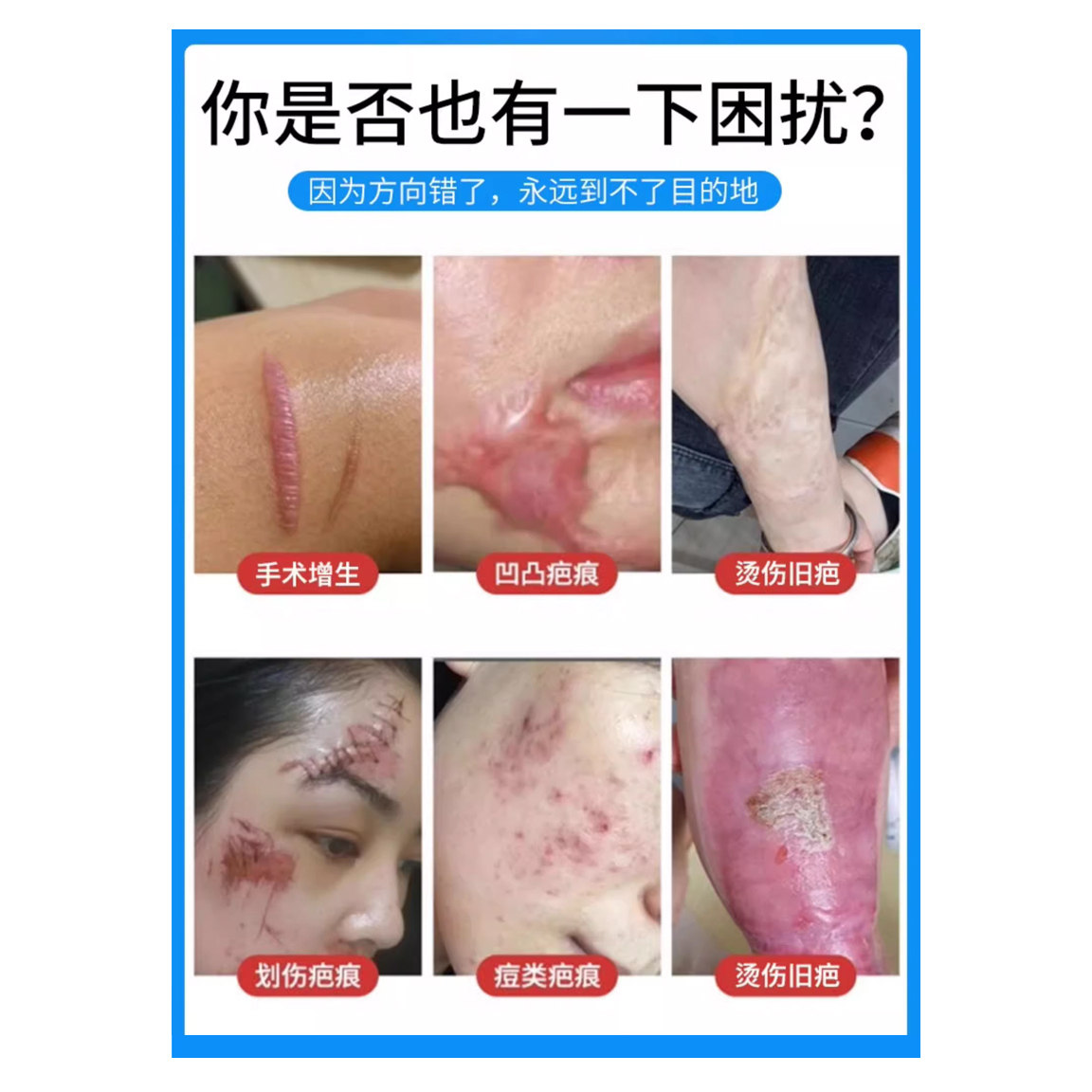 曲宁医用弹力手套胳膊臂套疤痕增生加压烧烫伤压力套防增生,淘宝优惠券,粉丝福利购,淘宝优惠卷