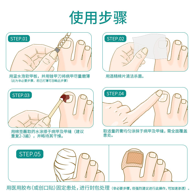 治疗灰指甲抗真菌感染旗舰店正品 硬核医生医药癣症