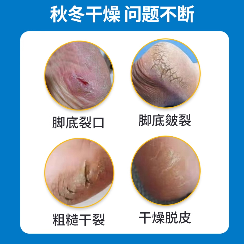 专治脚裂脚后跟干裂起硬皮足跟开裂真菌感染防皲裂脱皮修复药膏ZZ - 图1