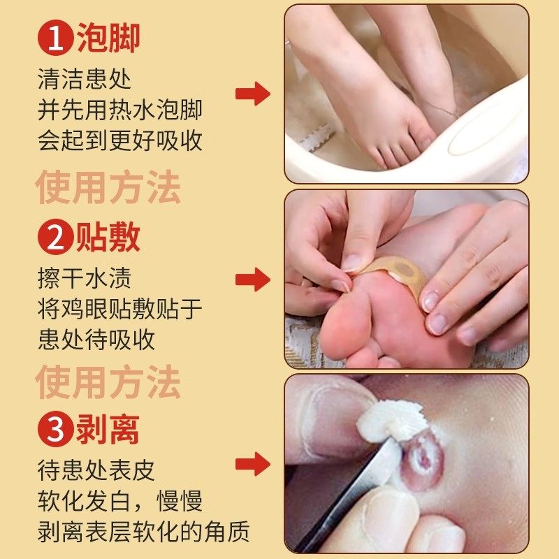 北京同仁堂御医匠鸡眼贴鸡眼膏鸡茧膏鸡贴眼膏去除老茧根脚底zz,淘宝优惠券,粉丝福利购,淘宝优惠卷