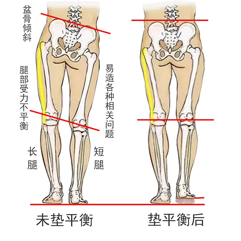 儿童长短腿内增高鞋垫成人高低斜肩盆骨倾斜单只腿短增高矫正鞋垫 - 图0