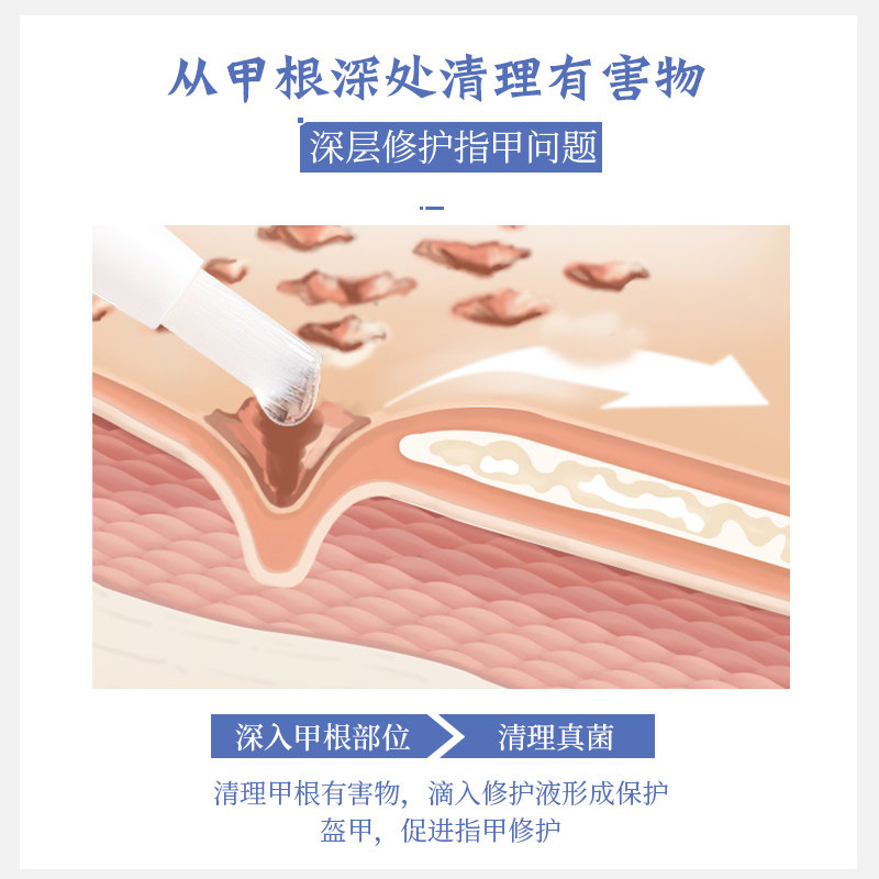软函甲康灵抑菌正品灰指甲液 软函医疗器械保健理疗