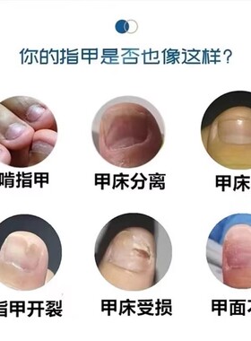 指甲游离线生长液护甲油萎缩增长液延长养甲床分离营养油空甲修复