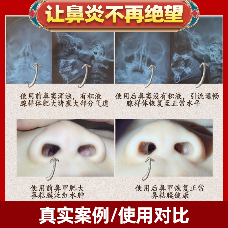 鼻炎膏正品苗家鼻窦炎专用膏过敏性鼻塞通鼻神器官方旗舰店治