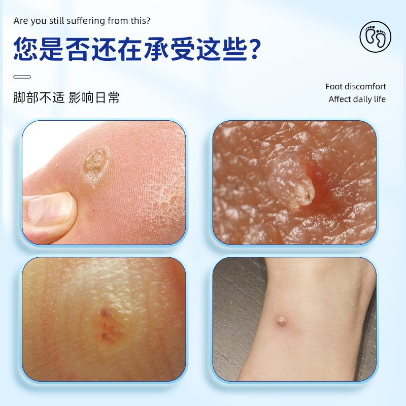 【葵花】跖疣专用膏去寻常疣根病毒拓趾足部根立净脚底鸡眼肉刺dq