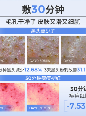【双11预售】希川科颜五酸面膜水杨酸冻膜控油祛痘去黑头闭口粉刺