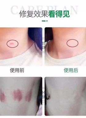 吻痕草莓印消除去草莓印吻痕神器快速消除草莓印脖子专用