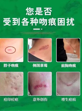 吻痕草莓印消除去草莓印吻痕神器快速消除草莓印脖子专用去疤痕膏