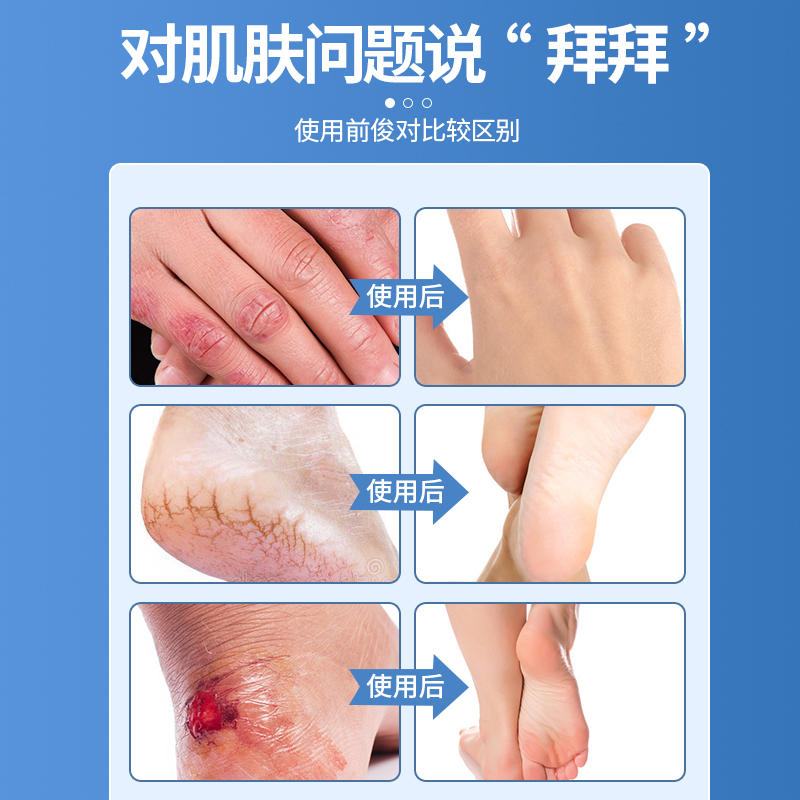 日本叮叮皴裂膏脚后跟干裂修复霜滋润护脚足霜龟裂皲裂官方旗舰店