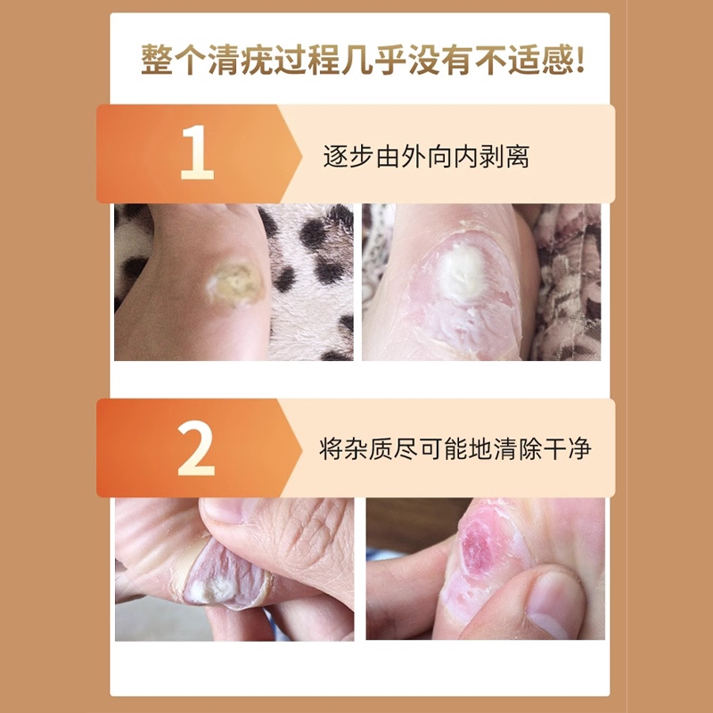 跖疣专用膏去除石疣脚底趾疣血胞刺去鸡眼拓尤必净清尤敷料根DF_虎窝淘