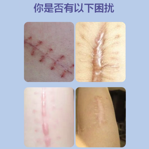 缝针疤痕修除疤膏复手术伤口刀口祛疤贴术后增生凸起去除疙瘩JW - 图0