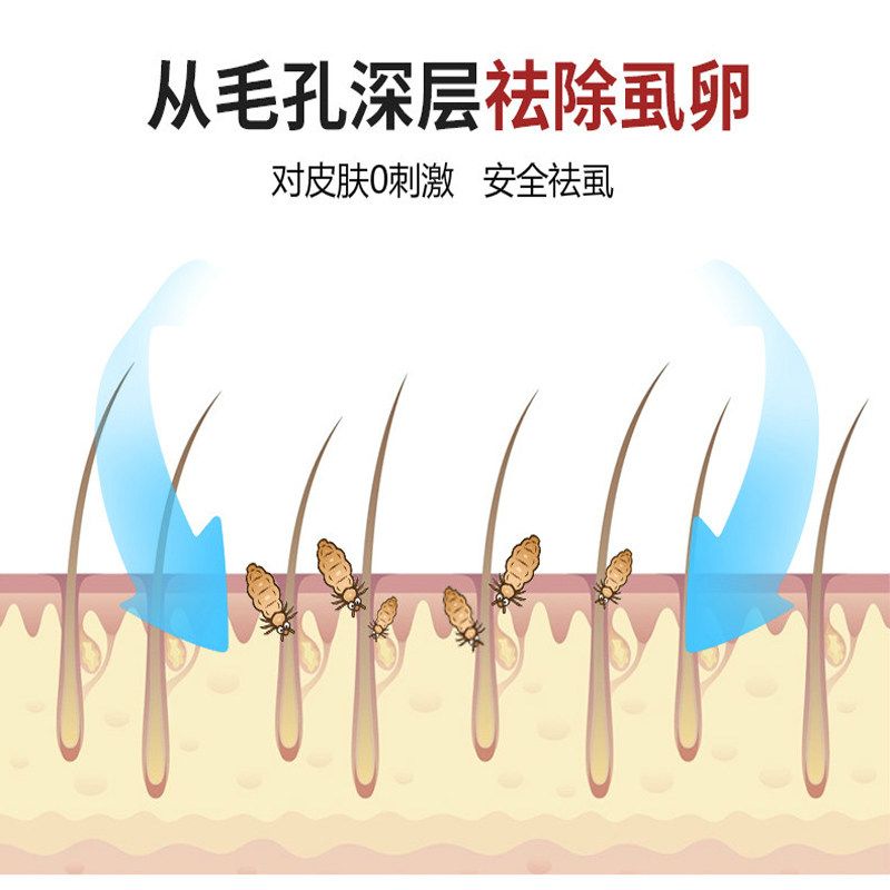 头虱水小女孩百部酊儿童头发去虱卵除阴虱头上的一扫光去虱子非药
