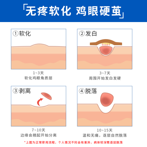 Gehwol洁沃德国鸡眼贴去除脚趾脚底老茧帖足部鸡贴眼鸡眼膏2盒装