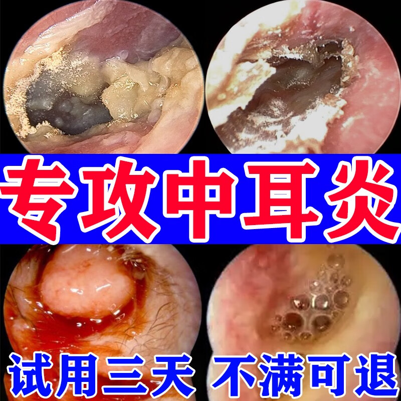 滴耳油中耳炎专用药滴耳液中耳炎人用不可除根特效药膏消炎耳聋DT - 图1