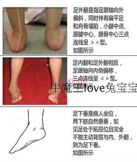 足内翻矫正器成人 新人首单立减十元 22年4月 淘宝海外