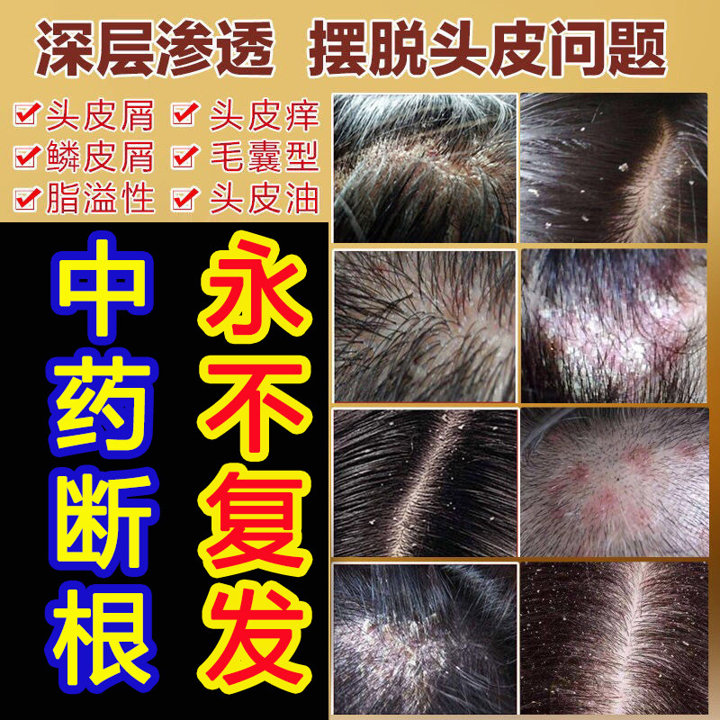 治头皮屑推荐品牌 新人首单立减十元 21年6月 淘宝海外