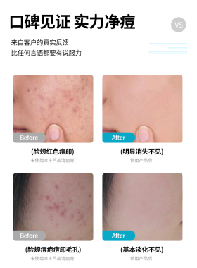 冰王芦荟清痘膏痘痘印黑头淡化