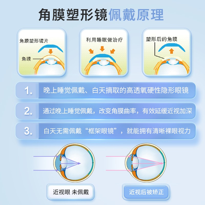 【成都何氏眼科】普诺瞳角膜塑形镜OK镜进口定制丨控制近视增长-图1