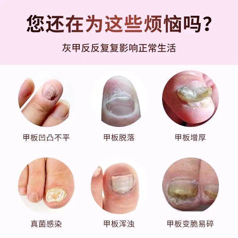 修正灰指甲抑菌液冰醋酸亮甲修脚刀 世修堂大药房保健理疗