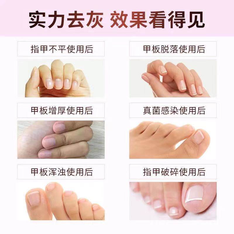 修正灰指甲抑菌液冰醋酸亮甲修脚刀 世修堂大药房保健理疗