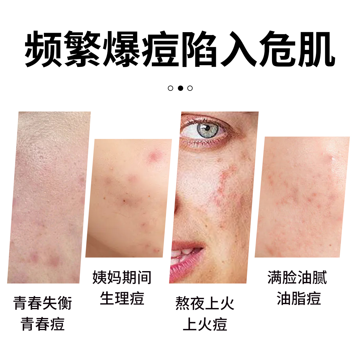 德国普拉赫茶树精油面霜祛痘淡化痘印调理痘痘粉刺官方正品250ml