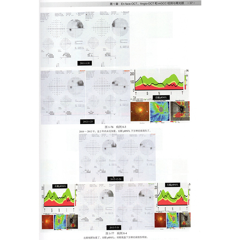 正版现货 En face-OCT及Angio-OCT技术与mGCC相关病变临床病变应用思考孙心铨科学出版社-图4