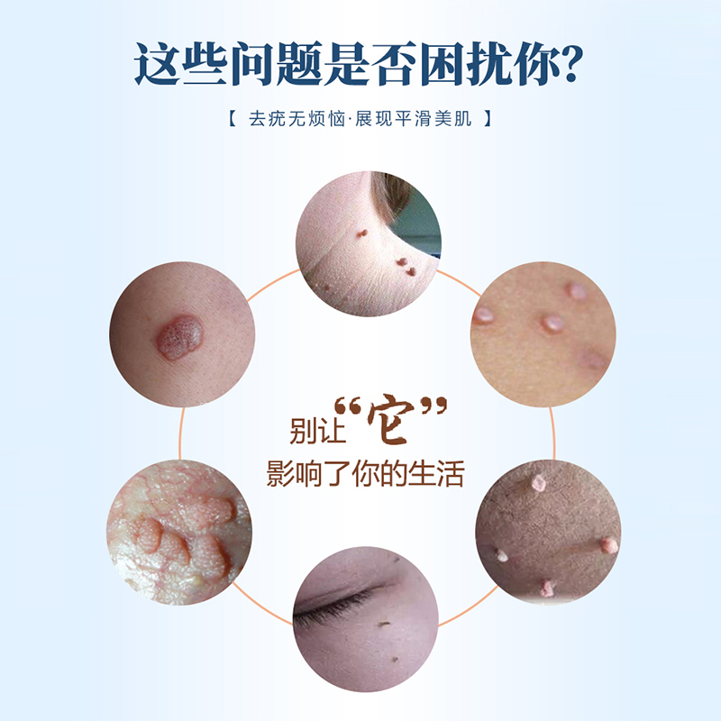 hpv去疣药膏水男女性生殖器肛门内尖锐湿疣根尤乳北京同仁堂 - 图0