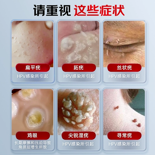 草医扁鹊 Настоящий гель для удаления бородавок.