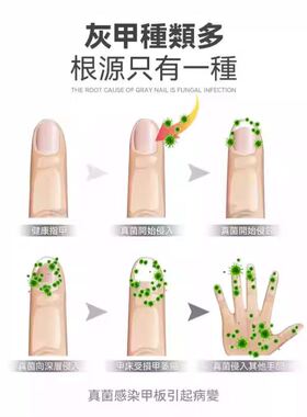 正品美欧专研智能灰趾甲光疗机杀真[菌]灯美甲灯灰趾激光机仪器