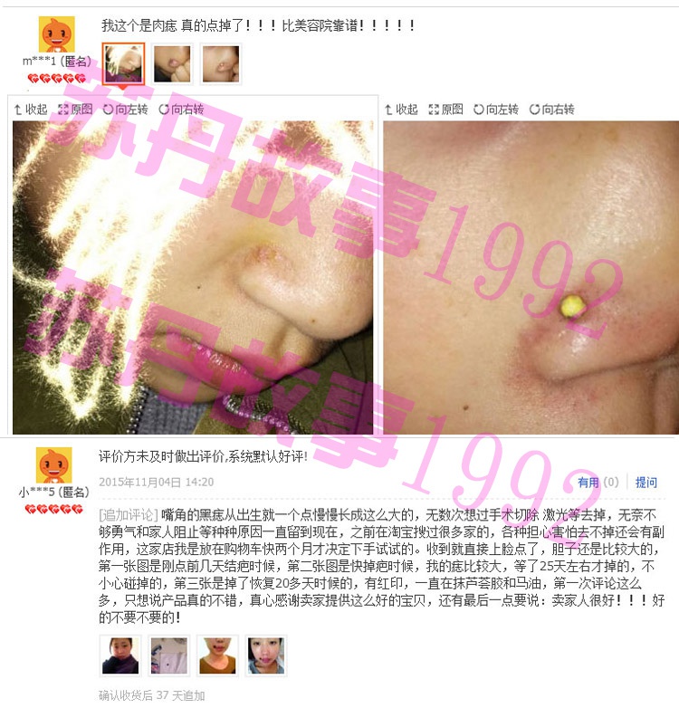 新款新品点黑痣美容院专用凸痣去肉痣点肉瘊点志膏不留痕祛黑痣包