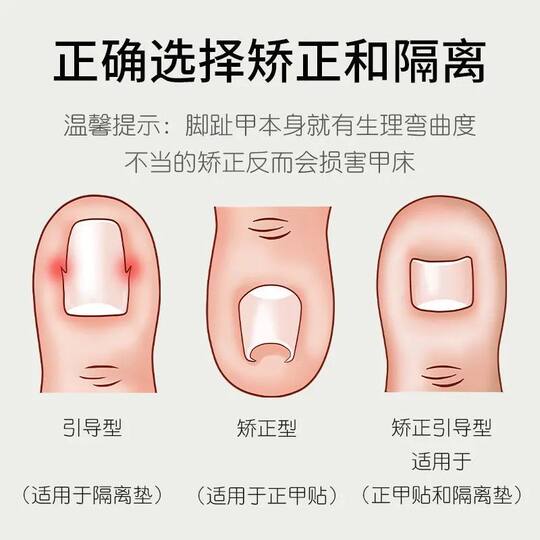 Ingrown toenail correction pad | Over 6,000 additional purchases