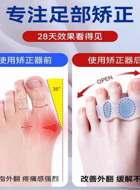 拇指外翻脚趾矫正器修正大母脚趾外翻分趾器重叠分离器硅胶可穿鞋