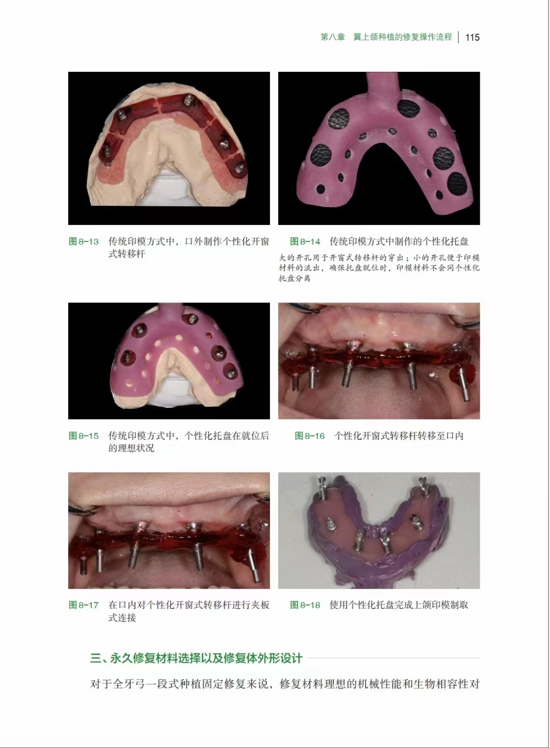 全新正版 翼上颌种植实战精要 附案例解析 舒凌 任杰 主编 上海科学技术出版社 适合口腔种植科医师阅读 上颌磨牙区垂直骨高度不足