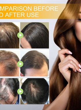 Fast Hair Growth Spray Products Anti Hair Loss Serum Prevent