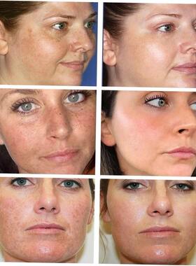 Whitening Freckle Cream Remove Melasma Cream Remove Dark Spo