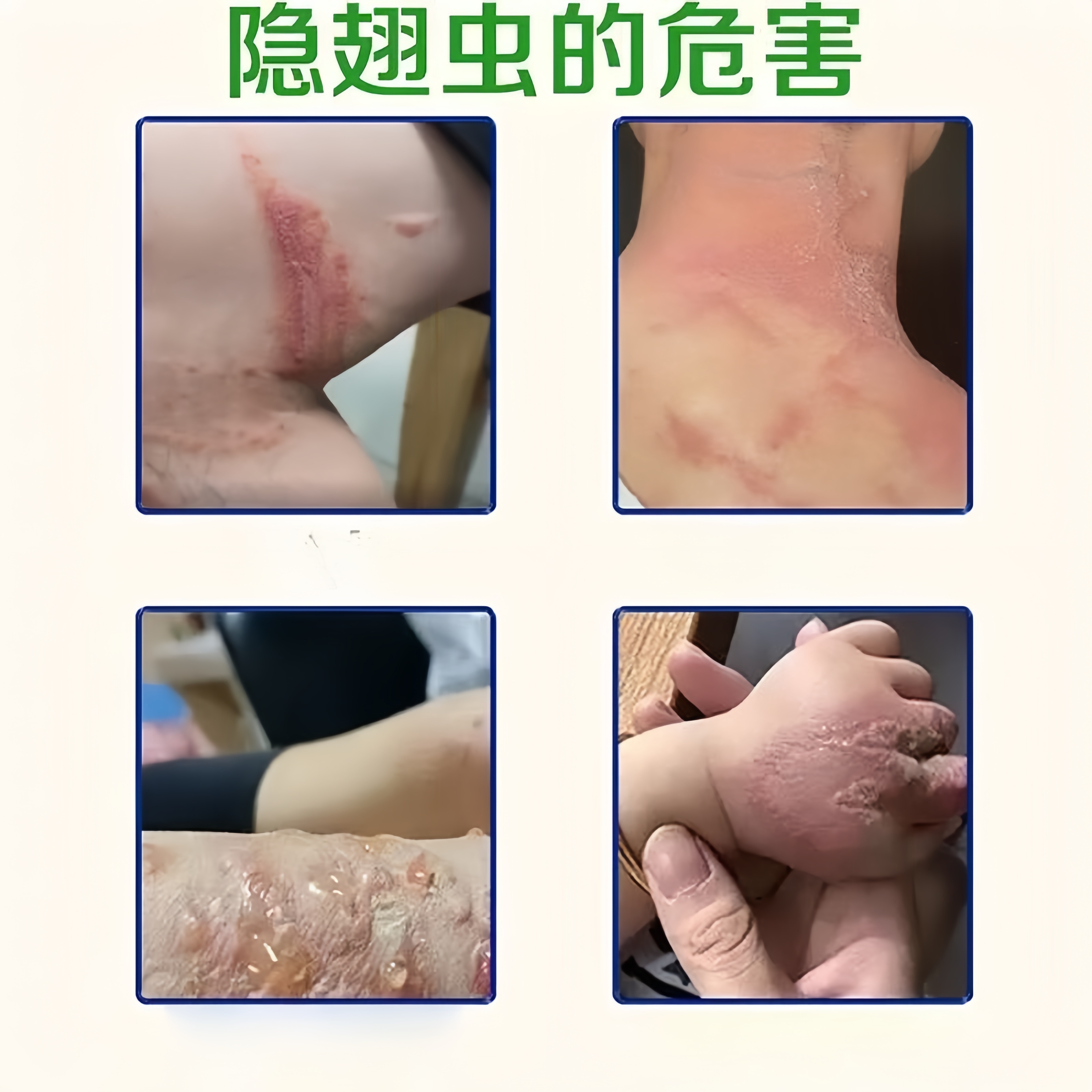 隐翅虫咬伤药膏红火蚁防蠓虫臭虫毒虫蚊虫叮咬消肿止痒膏专用神器 - 图0