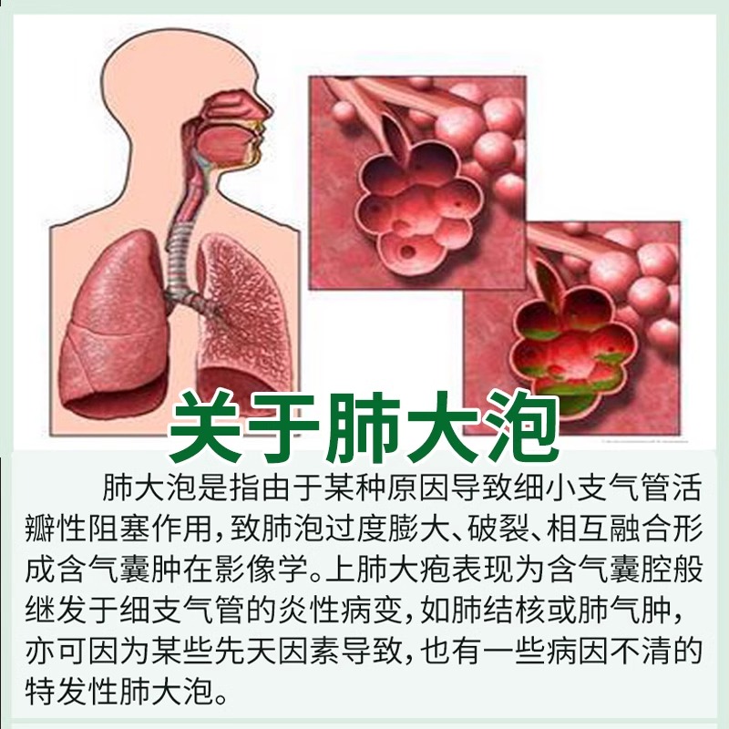 肺大泡特效药清肺止咳化痰治疗肺气肿胸闷气短支气管炎平喘专用贴-图1