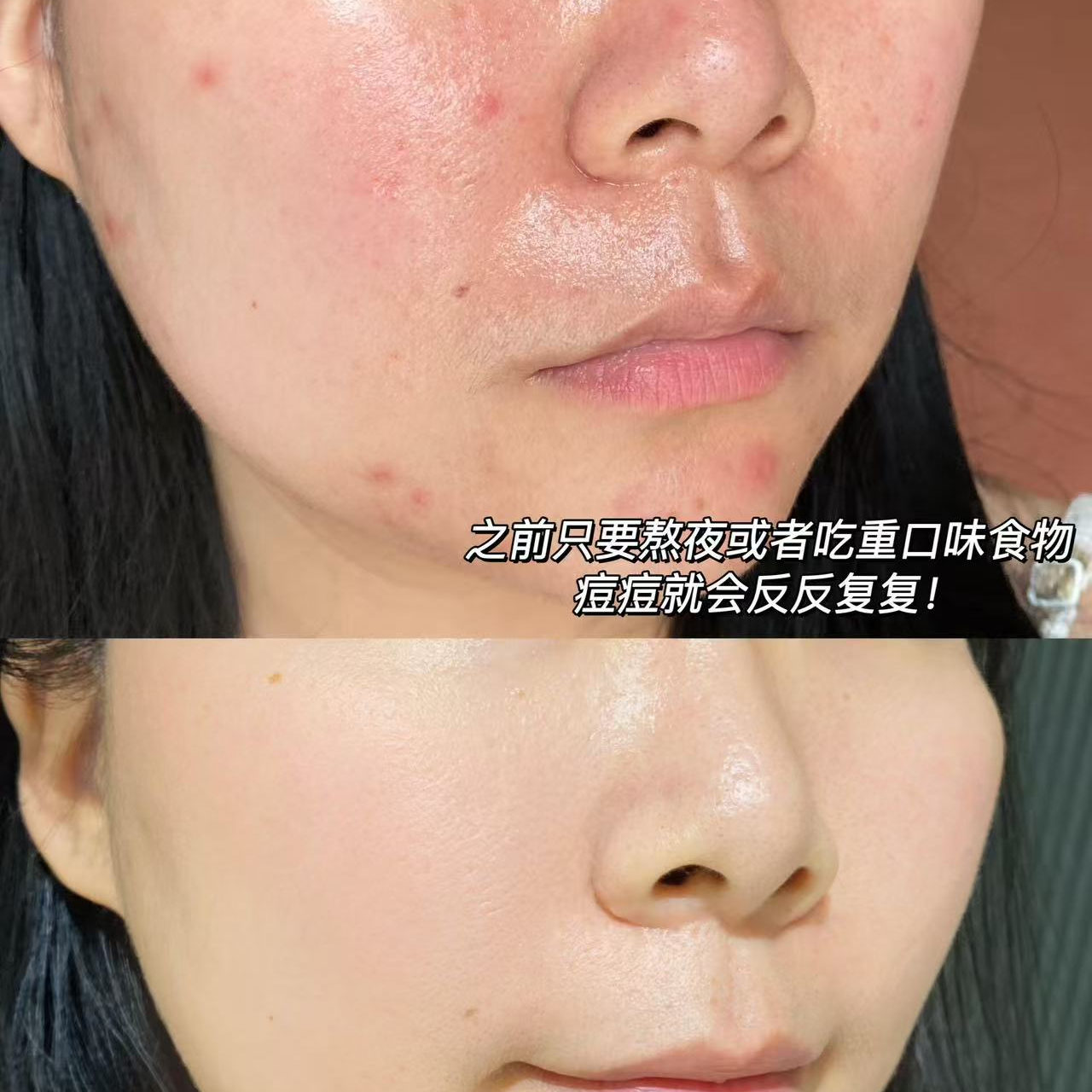 溪木源愈创木水乳抗痘套装祛痘精华水控油补水保湿修护油痘敏感肌 - 图3