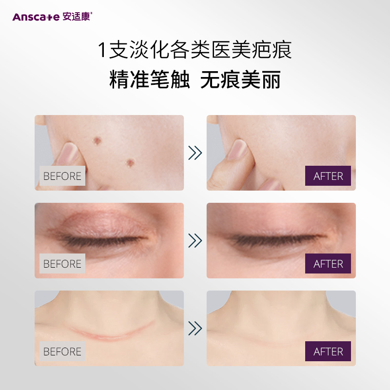 安适康祛疤膏修复除疤增生祛疤剖腹产术后官方正品疤贴儿童旗舰店